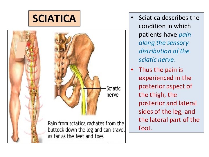 SCIATICA • Sciatica describes the condition in which patients have pain along the sensory