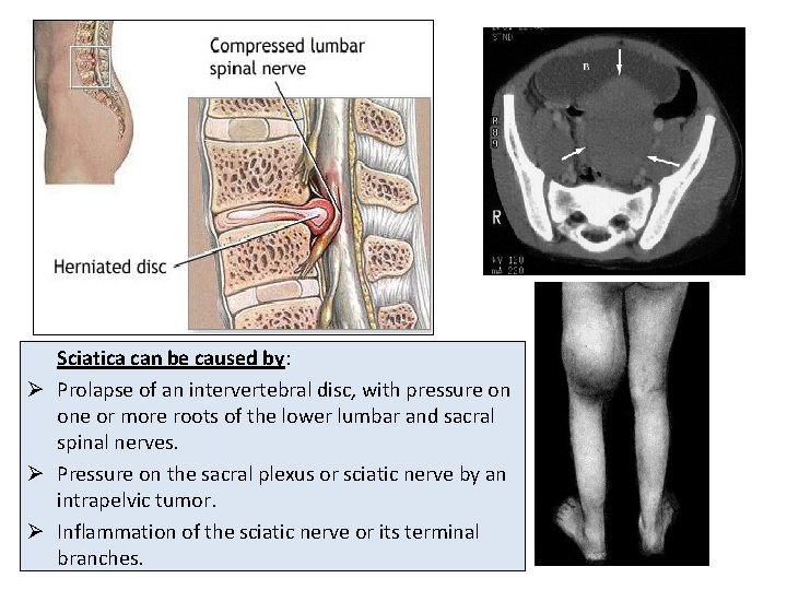 Sciatica can be caused by: Ø Prolapse of an intervertebral disc, with pressure on