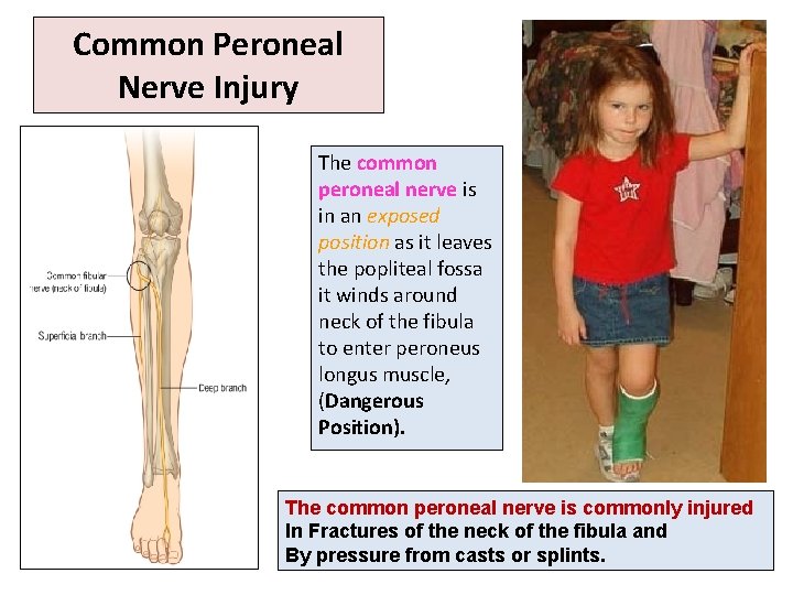 Common Peroneal Nerve Injury The common peroneal nerve is in an exposed position as