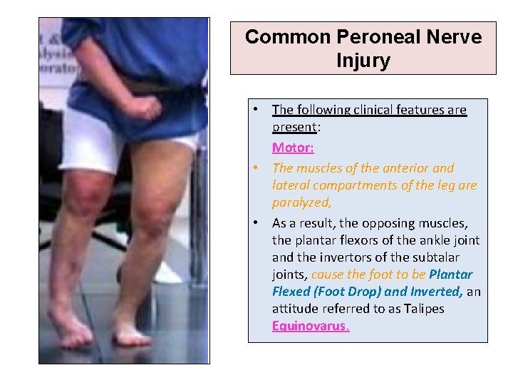 Common Peroneal Nerve Injury • The following clinical features are present: Motor: • The