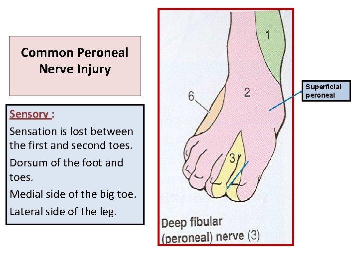 Common Peroneal Nerve Injury Superficial peroneal Sensory : Sensation is lost between the first