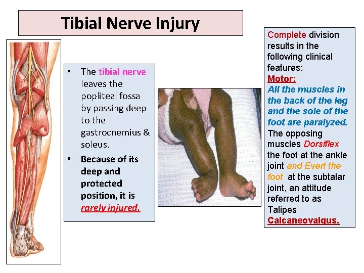 Tibial Nerve Injury • The tibial nerve leaves the popliteal fossa by passing deep