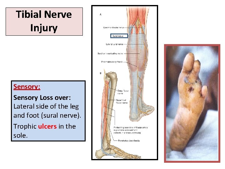 Tibial Nerve Injury Sensory: Sensory Loss over: Lateral side of the leg and foot