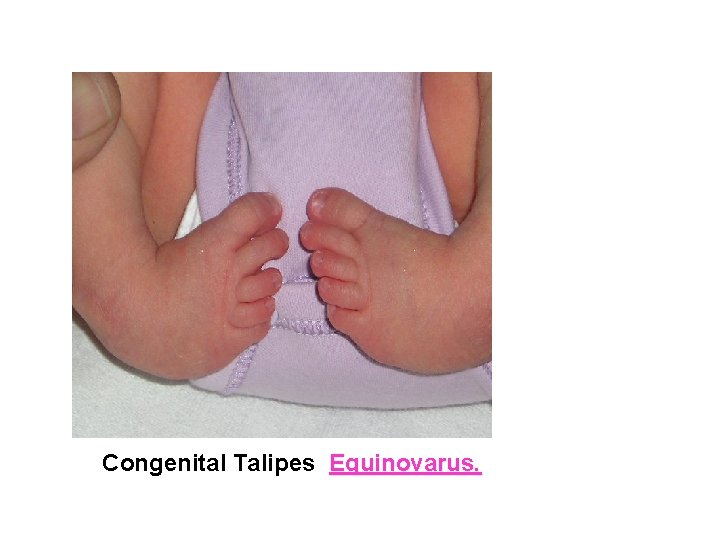 Congenital Talipes Equinovarus. 