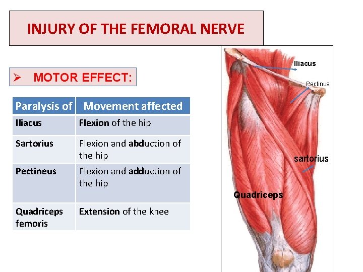 INJURY OF THE FEMORAL NERVE Iliacus Ø MOTOR EFFECT: Pectinus Paralysis of Movement affected