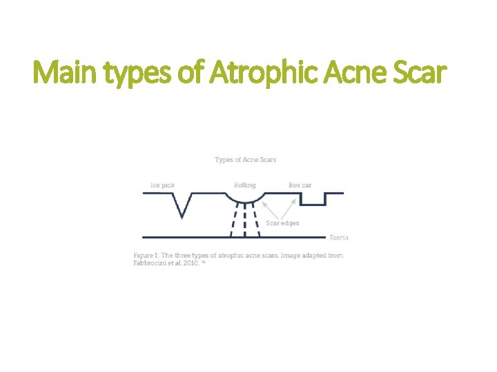 Main types of Atrophic Acne Scar 