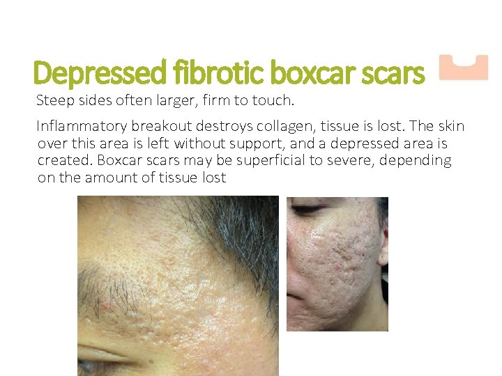 Depressed fibrotic boxcar scars Steep sides often larger, firm to touch. Inflammatory breakout destroys
