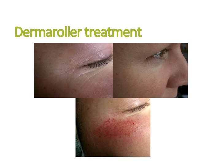 Dermaroller treatment 