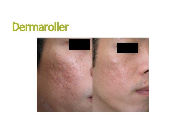 Dermaroller 