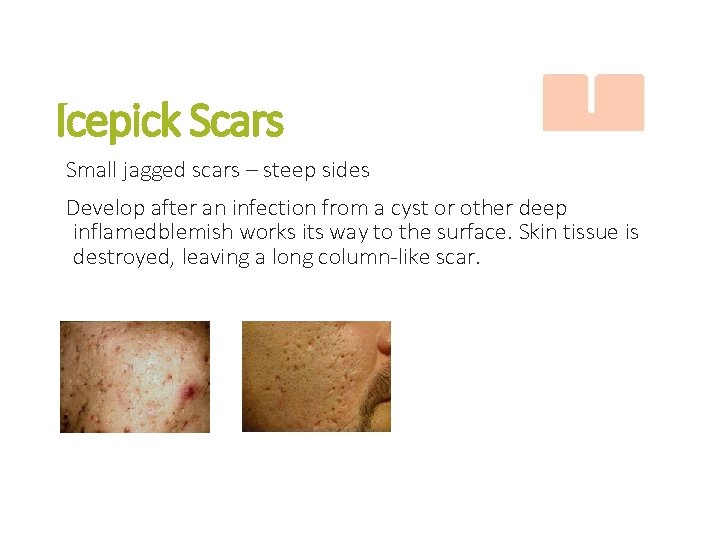 Icepick Scars Small jagged scars – steep sides Develop after an infection from a