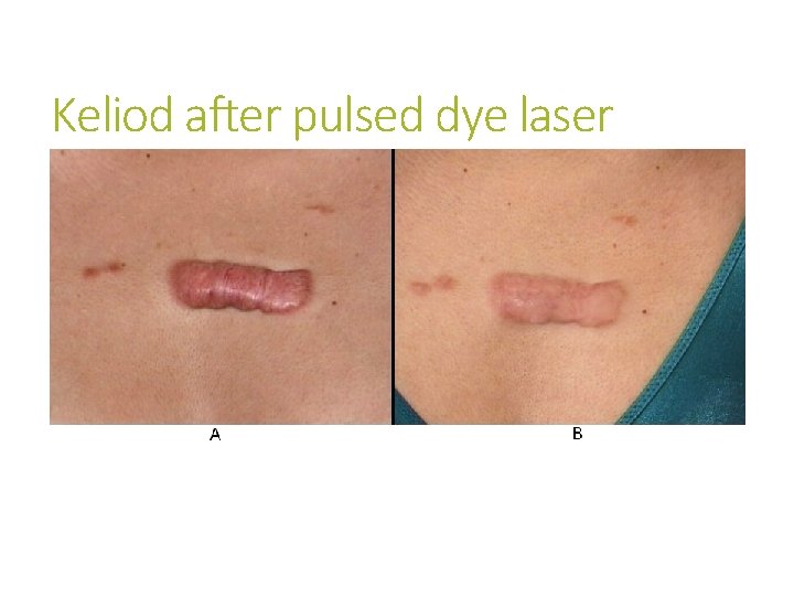 Keliod after pulsed dye laser 