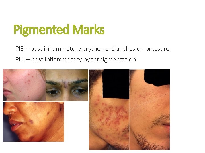 Pigmented Marks PIE – post inflammatory erythema-blanches on pressure PIH – post inflammatory hyperpigmentation