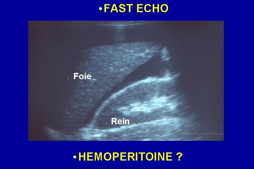  • FAST ECHO l Foie l Rein • HEMOPERITOINE ? 