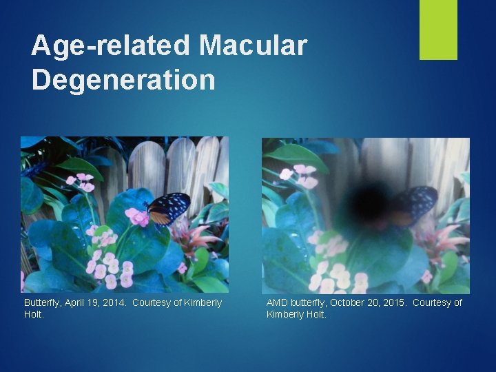 Age-related Macular Degeneration Butterfly, April 19, 2014. Courtesy of Kimberly Holt. AMD butterfly, October