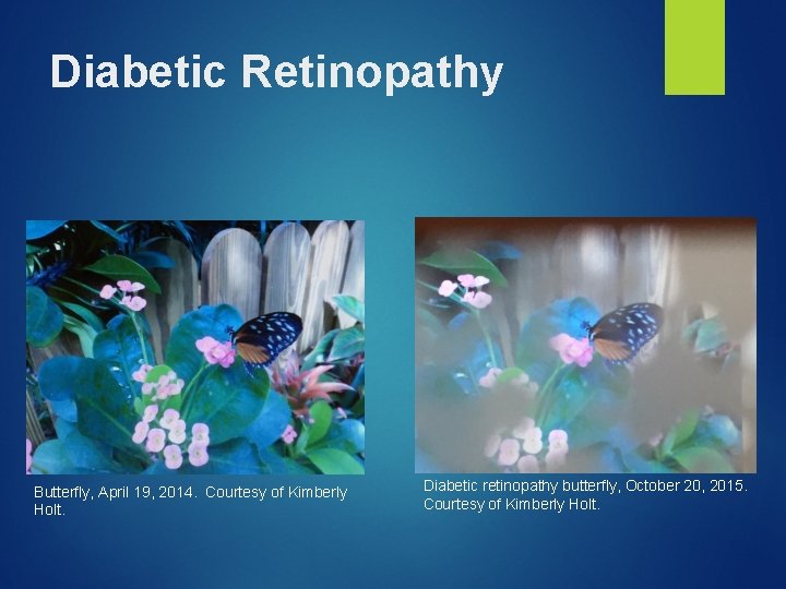 Diabetic Retinopathy Butterfly, April 19, 2014. Courtesy of Kimberly Holt. Diabetic retinopathy butterfly, October