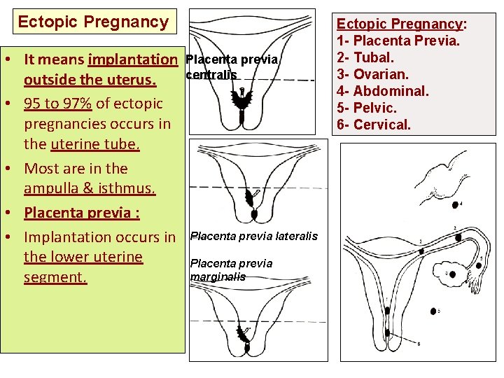 Ectopic Pregnancy • It means implantation outside the uterus. • 95 to 97% of