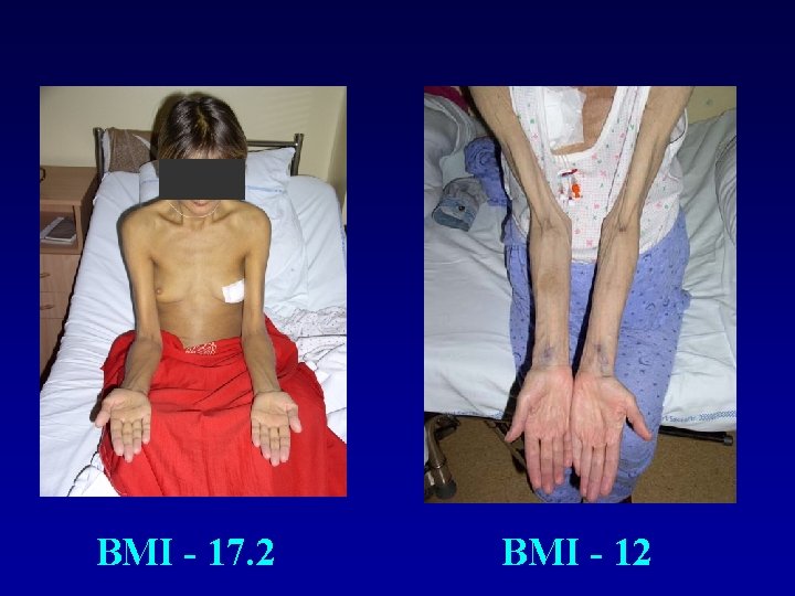 BMI - 17. 2 BMI - 12 