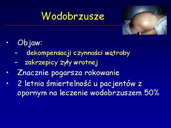 Wodobrzusze • Objaw: – – • • dekompensacji czynności wątroby zakrzepicy żyły wrotnej Znacznie