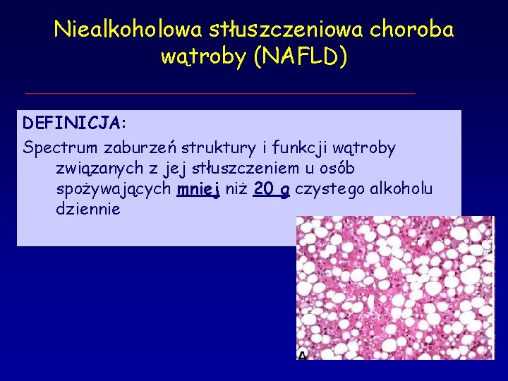 Niealkoholowa stłuszczeniowa choroba wątroby (NAFLD) DEFINICJA: Spectrum zaburzeń struktury i funkcji wątroby związanych z