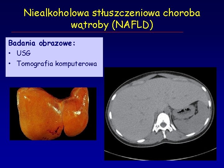 Niealkoholowa stłuszczeniowa choroba wątroby (NAFLD) Badania obrazowe: • USG • Tomografia komputerowa 