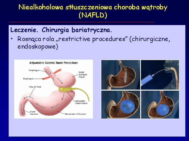 Niealkoholowa stłuszczeniowa choroba wątroby (NAFLD) Leczenie. Chirurgia bariatryczna. • Rosnąca rola „restrictive procedures” (chirurgiczne,