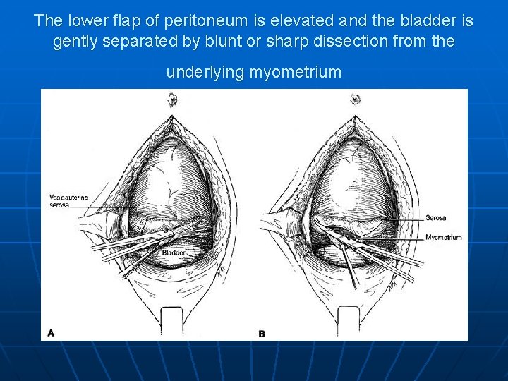 The lower flap of peritoneum is elevated and the bladder is gently separated by