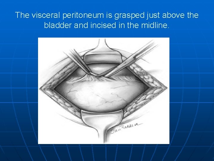 The visceral peritoneum is grasped just above the bladder and incised in the midline.