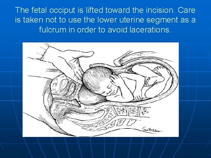 The fetal occiput is lifted toward the incision. Care is taken not to use