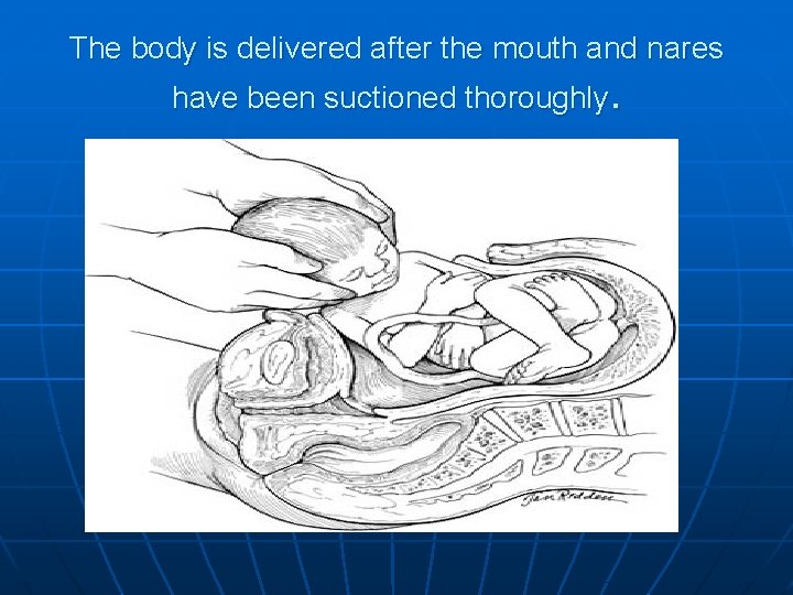 The body is delivered after the mouth and nares have been suctioned thoroughly. 