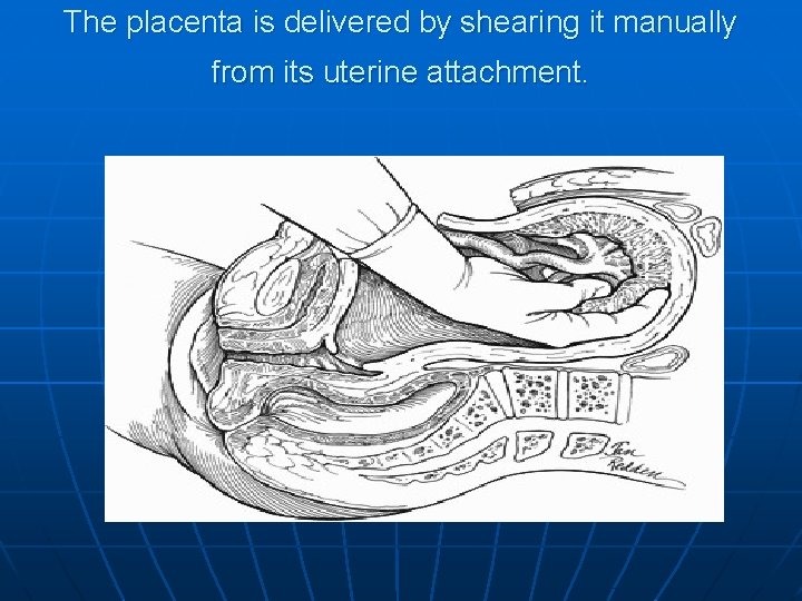 The placenta is delivered by shearing it manually from its uterine attachment. 