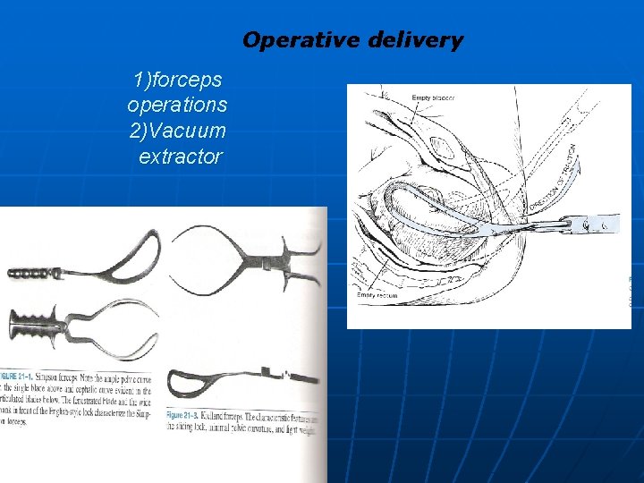 Operative delivery 1)forceps operations 2)Vacuum extractor 