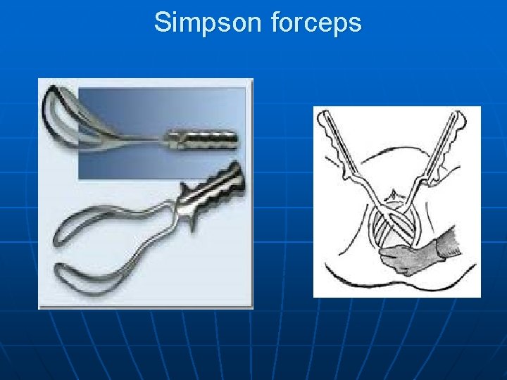 Simpson forceps 