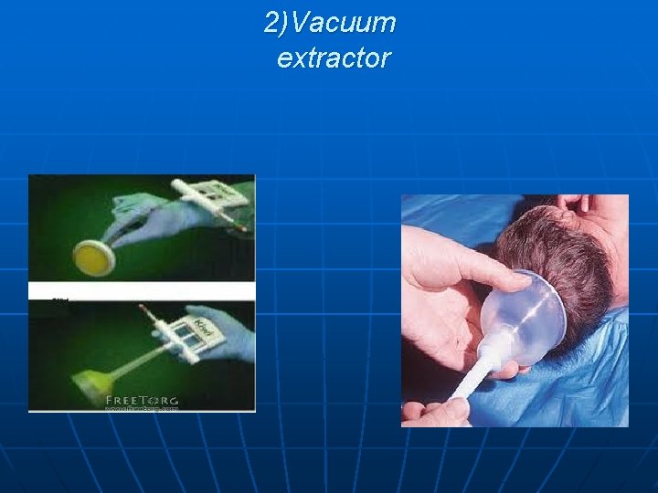 2)Vacuum extractor 