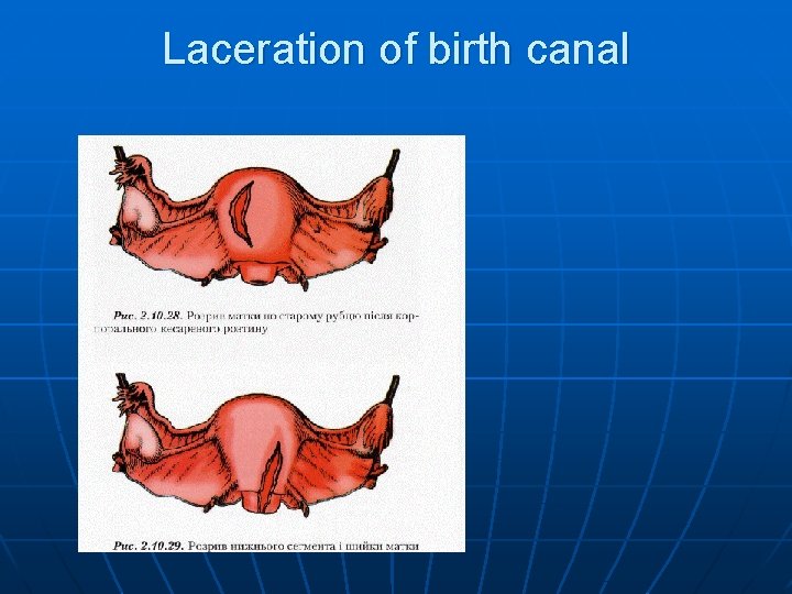 Laceration of birth canal 