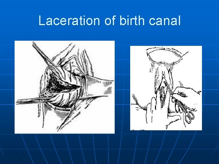 Laceration of birth canal 