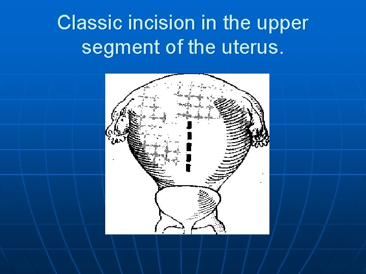 Classic incision in the upper segment of the uterus. 