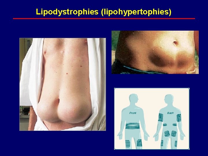 Lipodystrophies (lipohypertophies) 