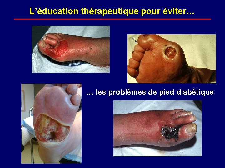 L’éducation thérapeutique pour éviter… … les problèmes de pied diabétique 