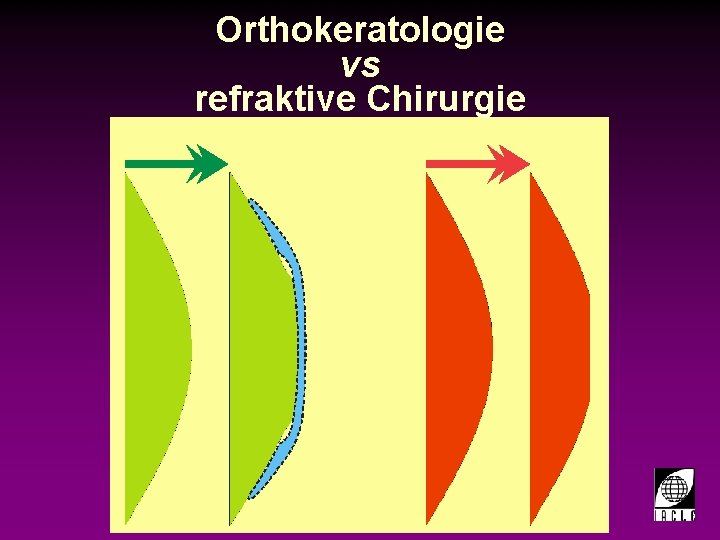 Orthokeratologie vs refraktive Chirurgie 998700 -10 S. PPT 