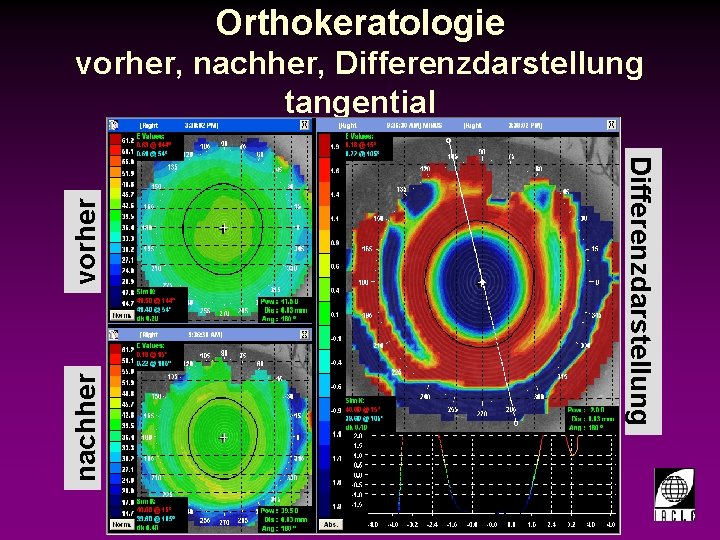 Orthokeratologie vorher, nachher, Differenzdarstellung tangential nachher vorher Differenzdarstellung 998700 -18 S. PPT 