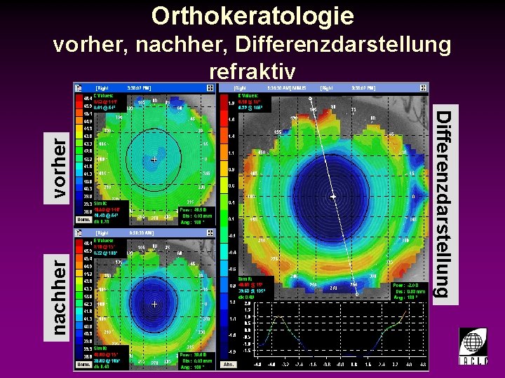 Orthokeratologie vorher, nachher, Differenzdarstellung refraktiv nachher vorher Differenzdarstellung 998700 -19 S. PPT 