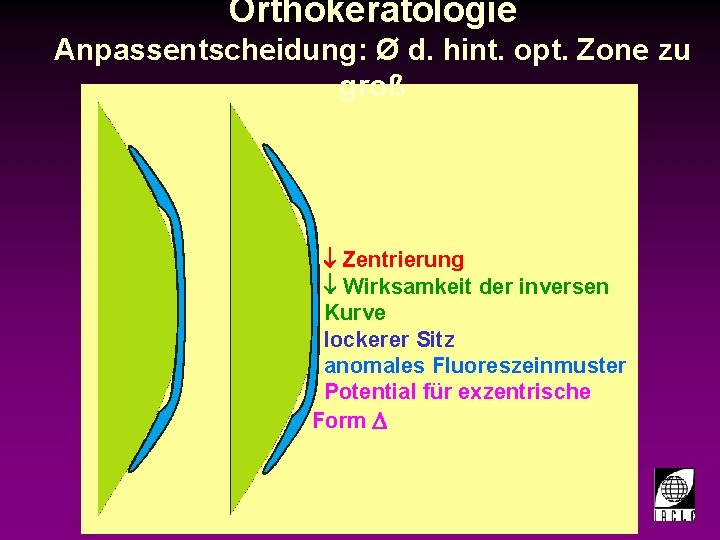 Orthokeratologie Anpassentscheidung: Ø d. hint. opt. Zone zu groß ¯ Zentrierung ¯ Wirksamkeit der