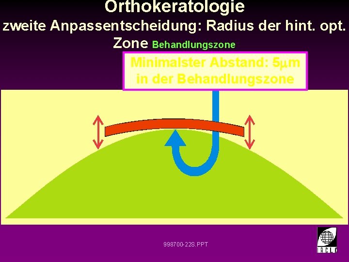 Orthokeratologie zweite Anpassentscheidung: Radius der hint. opt. Zone Behandlungszone Minimalster Abstand: 5 m in