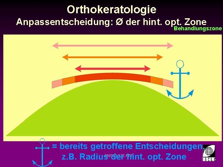 Orthokeratologie Anpassentscheidung: Ø der hint. opt. Zone Behandlungszone = bereits getroffene Entscheidungen, z. B.