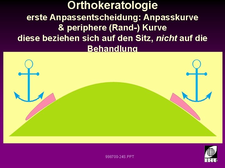 Orthokeratologie erste Anpassentscheidung: Anpasskurve & periphere (Rand-) Kurve diese beziehen sich auf den Sitz,