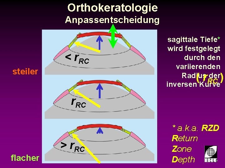 Orthokeratologie Anpassentscheidung sagittale Tiefe* wird festgelegt durch den variierenden Radius der) ( r. RC