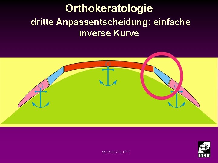 Orthokeratologie dritte Anpassentscheidung: einfache inverse Kurve 998700 -27 S. PPT 