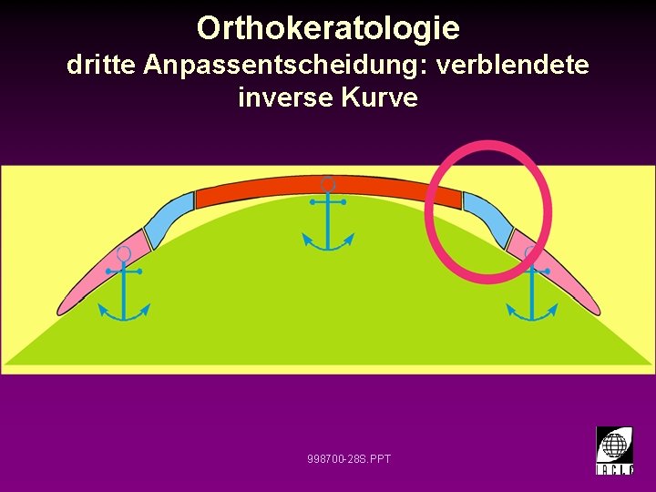 Orthokeratologie dritte Anpassentscheidung: verblendete inverse Kurve 998700 -28 S. PPT 