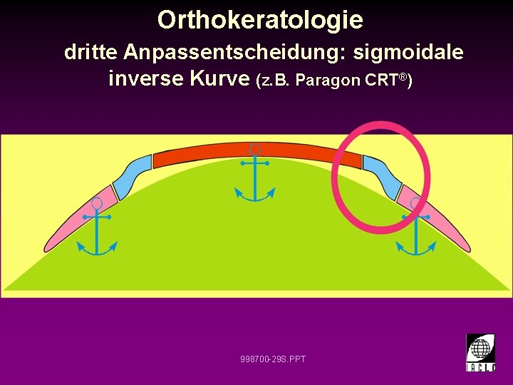 Orthokeratologie dritte Anpassentscheidung: sigmoidale inverse Kurve (z. B. Paragon CRT®) 998700 -29 S. PPT