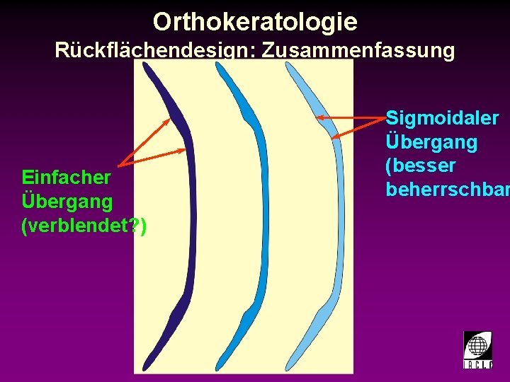 Orthokeratologie Rückflächendesign: Zusammenfassung Sigmoidaler Übergang (besser beherrschbar Einfacher Übergang (verblendet? ) 998700 -30 S.
